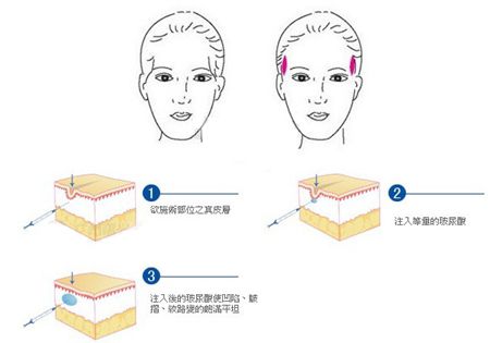 太阳穴填用玻尿酸优点有什么