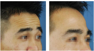 有效的祛除抬头纹的方法?