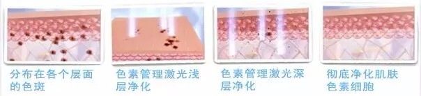 �Ͼ���Ƥ�뼤��ȥȸ��Ҫ������?