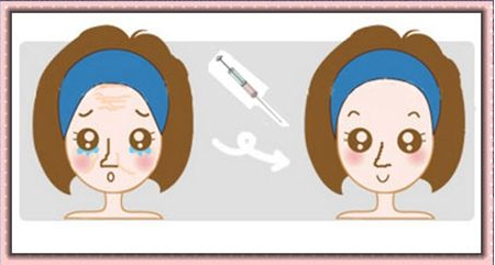 去除皱纹可以注射**吗?