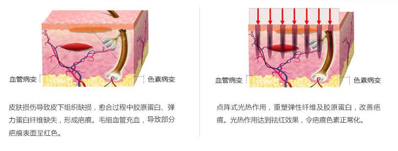 南京激光祛除疤痕需要做几次?