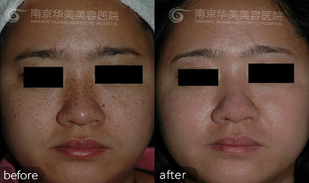 南京面部有雀斑怎么办