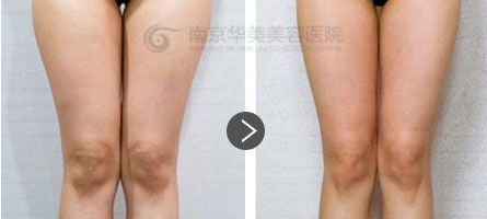 �Ͼ����Ȳ���֬������ҪסԺ��