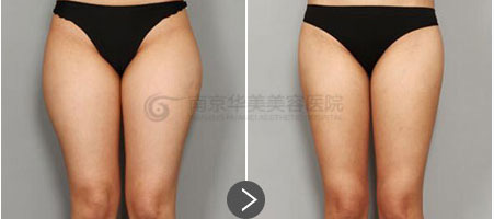 南京做腿部吸脂后会出现皮肤松弛吗